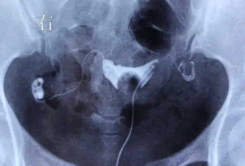 輸卵管檢查能幫助女性知道自己生育能力，做一次檢查的費用看完就知