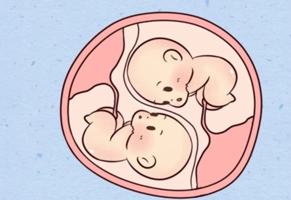 做試管嬰兒懷上**需要做減胎手術嗎？