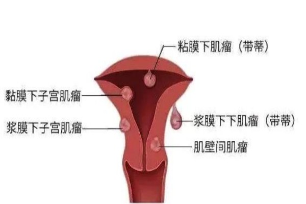 子宮肌瘤有哪些明顯的癥狀表現(xiàn)？