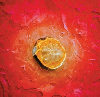 為什么醫(yī)生不建議患有多囊的女性做試管？