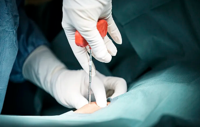 干細(xì)胞有填充功效嗎？適用于哪些情況？