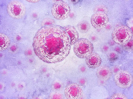 臺州糖尿病干細胞功效及治療實例分析。