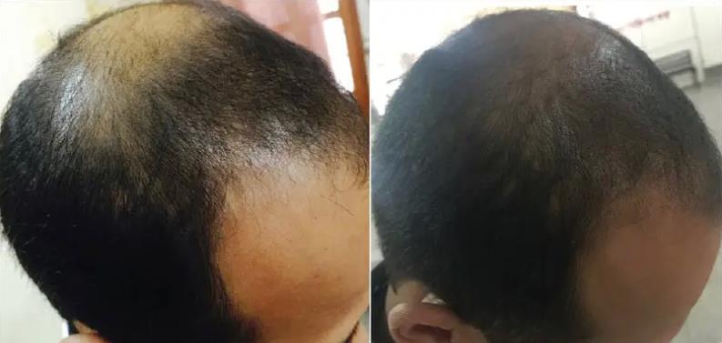 治療脫發(fā)除了植發(fā)，你還有很多選擇