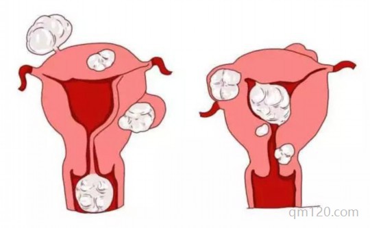 子宮肌瘤