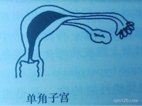 單角子宮試管成功案例