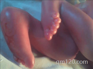 火棉膠嬰兒怎么引起的