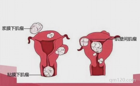 子宮腺肌癥