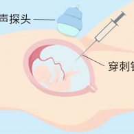 羊水穿刺