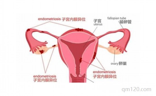 內(nèi)膜異位癥