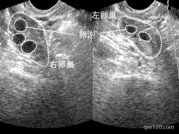 試管促排卵泡大小不均勻怎么辦