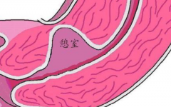 子宮憩室做試管成功率