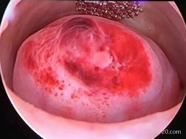 移植前內(nèi)膜是不是都是C型