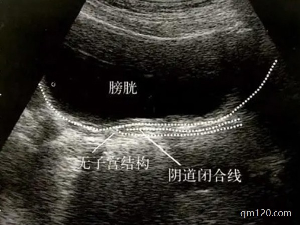 無子宮有卵巢如何生孩子