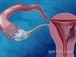 子宮肌瘤多大必須手術(shù)摘除
