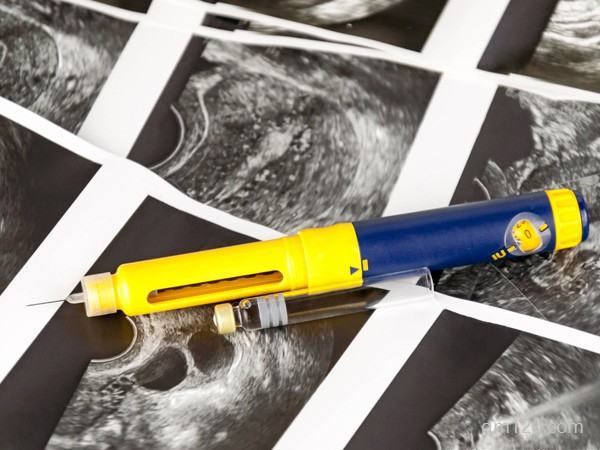 試管拮抗劑方案的利弊