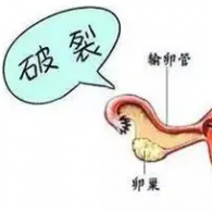 卵巢破裂