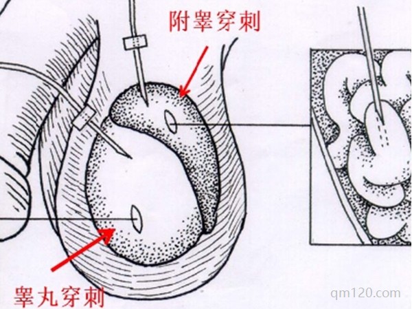 手術(shù)取精是穿刺睪丸還是附睪