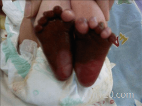 火棉膠嬰兒能治好嗎