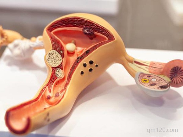 子宮腺肌癥試管成功案例