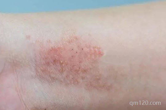 梅毒為什么毀三代