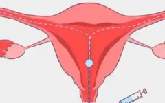 輸卵管復(fù)通手術(shù)大概需要多少費用