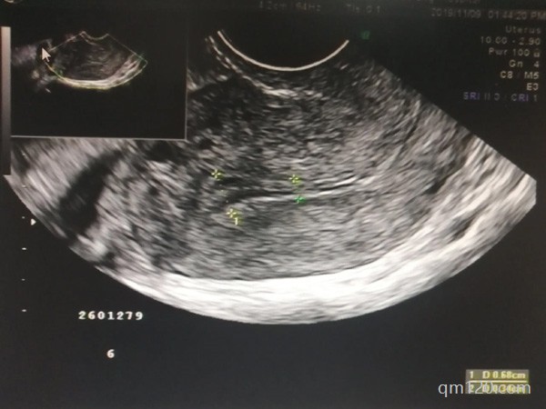 試管卵泡少只有3個怎么辦