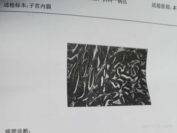 子宮內(nèi)膜6mm試管成功案例