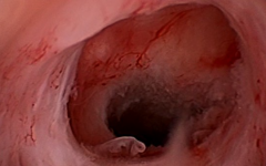 子宮憩室試管成功率多少