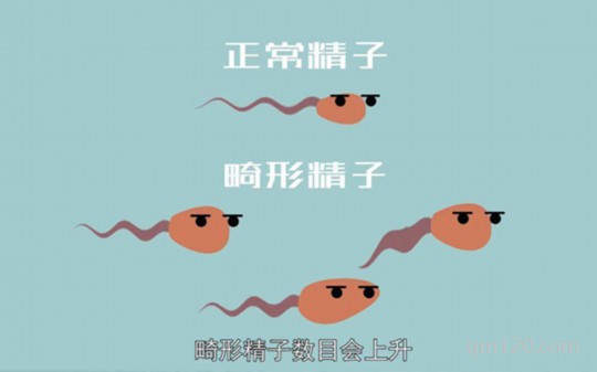 畸形精子