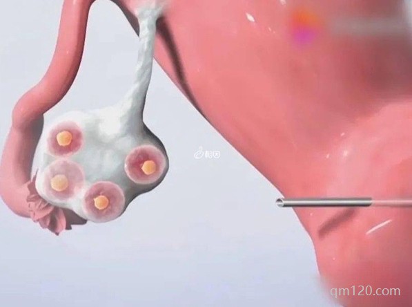 促排卵35個(gè)是不是太多了