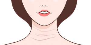 去頸紋比較好的方法是什么？去做什么項(xiàng)目會(huì)比較好？