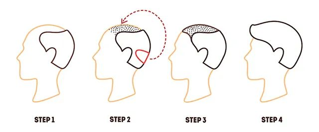 脫發(fā)該知道哪些小知識？