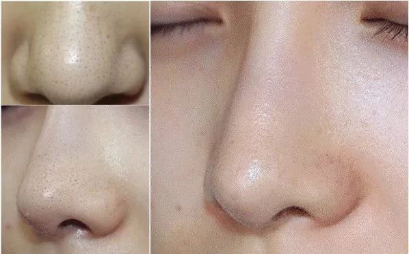 淄博市收縮鼻子毛孔醫(yī)院這些醫(yī)院受到一致好評！